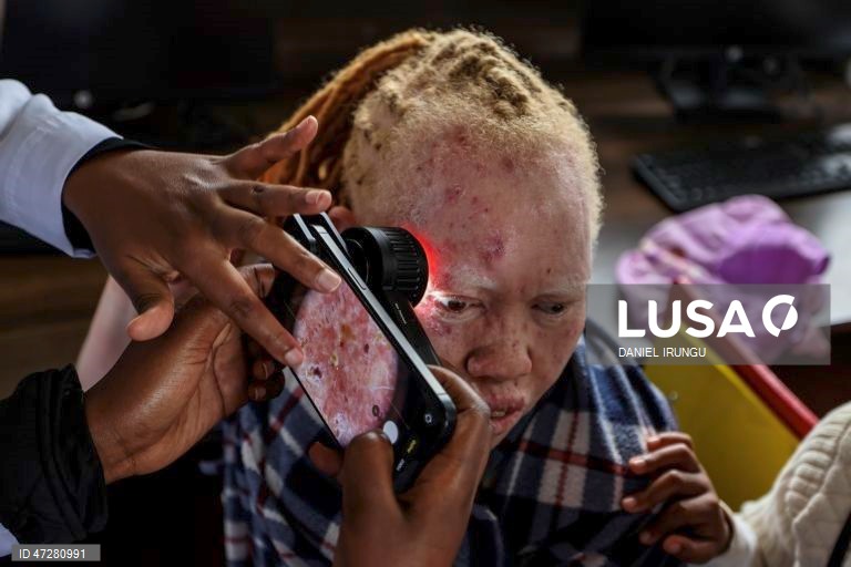Quénia: Dia Mundial de Consciencialização do Albinismo 