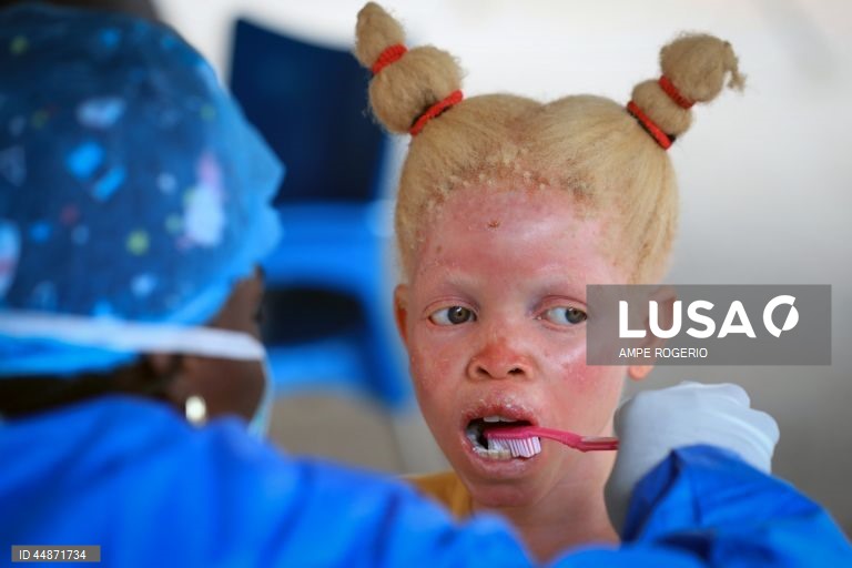 Médicos solidários levaram aos albinos do Bié “conforto e carinho” numa ação que permitiu diagnosticar casos de cancro de pele e outros problemas de saúde que atingem este grupo de pessoas, ainda alvo de preconceitos e discriminação, 26 de abril de 2025. (ACOMPANHA TEXTO DO DIA 03 DE MAIO DE 2025) AMPE ROGERIO/LUSA