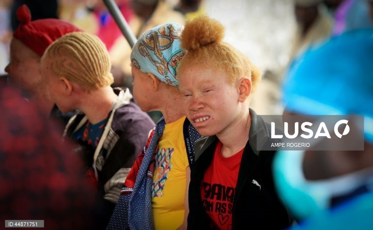 Médicos solidários levaram aos albinos do Bié “conforto e carinho” numa ação que permitiu diagnosticar casos de cancro de pele e outros problemas de saúde que atingem este grupo de pessoas, ainda alvo de preconceitos e discriminação, 26 de abril de 2025. (ACOMPANHA TEXTO DO DIA 03 DE MAIO DE 2025) AMPE ROGERIO/LUSA