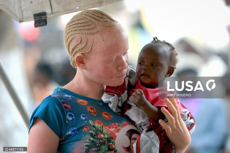 Médicos solidários levaram aos albinos do Bié “conforto e carinho” numa ação que permitiu diagnosticar casos de cancro de pele e outros problemas de saúde que atingem este grupo de pessoas, ainda alvo de preconceitos e discriminação, 26 de abril de 2025. (ACOMPANHA TEXTO DO DIA 03 DE MAIO DE 2025) AMPE ROGERIO/LUSA