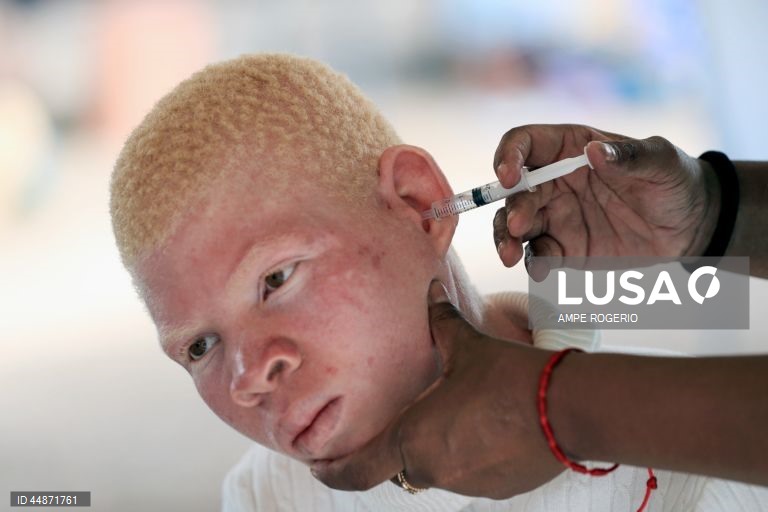 Médicos solidários levaram aos albinos do Bié “conforto e carinho” numa ação que permitiu diagnosticar casos de cancro de pele e outros problemas de saúde que atingem este grupo de pessoas, ainda alvo de preconceitos e discriminação, 26 de abril de 2025. (ACOMPANHA TEXTO DO DIA 03 DE MAIO DE 2025) AMPE ROGÉRIO/LUSA