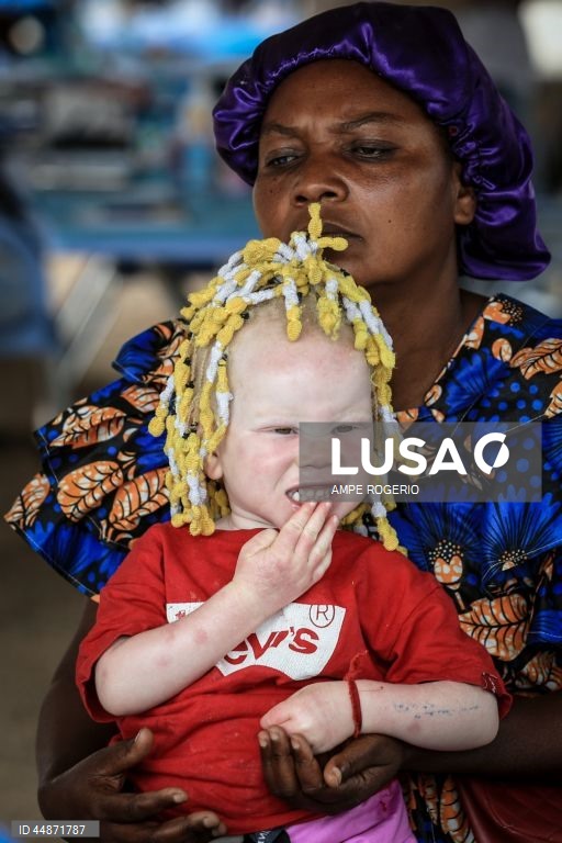 Médicos solidários levaram aos albinos do Bié “conforto e carinho” numa ação que permitiu diagnosticar casos de cancro de pele e outros problemas de saúde que atingem este grupo de pessoas, ainda alvo de preconceitos e discriminação, 26 de abril de 2025. (ACOMPANHA TEXTO DO DIA 03 DE MAIO DE 2025) AMPE ROGERIO/LUSA