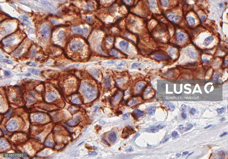 Campanha informa sobre os diferentes subtipos de cancro da mama