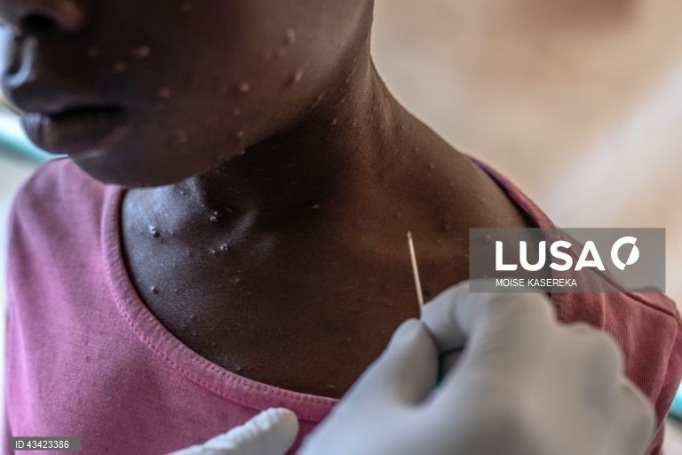 Moçambique confirma mais dois casos de Mpox em Maputo e 222 suspeitos
