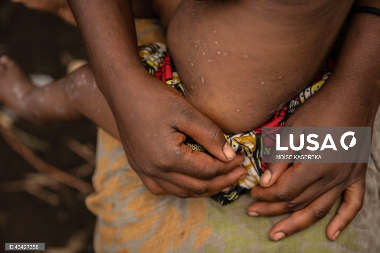 Moçambique reforça vigilância fronteiriça para travar propagação de casos de mpox