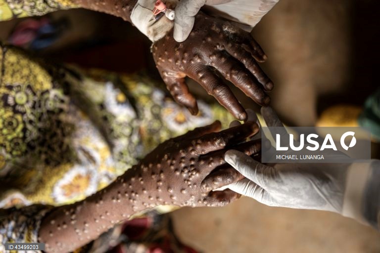 Confirmados mais sete casos de Mpox em Moçambique e 36 suspeitos