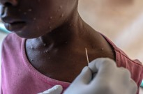 Moçambique confirma mais dois casos de Mpox em Maputo e 222 suspeitos