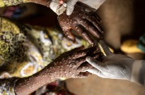 Número de casos de mpox em Moçambique sobe para 66 e suspeitos para 810