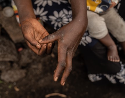 Número de infetados com mpox em Moçambique sobe para 38 e casos suspeitos para 325