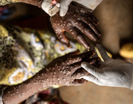 Número de infetados com Mpox em Moçambique sobe para 34 e casos suspeitos para 275